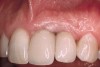Figure 4  The average height of a papilla between 2 implants is 3.4 mm. Note the short papilla between implant-supported crowns on teeth Nos. 9 and 10.