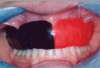 Figure 6  Mouthguard is seated; note the extension of the mouthguard into the vestibular regions.