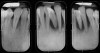 Figure 3  Intraoral radiographs exposed at initial periodontal evaluation.