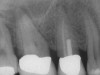 Figure 1a  Tooth No. 4 The patient had a nonsurgical root canal treatment with a crown restoration several years ago. Recently, the tooth became symptomatic. The preoperative radiograph revealed periapical pathology and an untreated canal with a post.