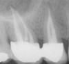 Figure 1d  A 1-year recall radiograph shows the complete resolution of the periapical radiolucency with a new restoration.