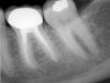 Figure 2a  Tooth No. 19 A new coronal restoration had been recently placed after root canal treatment. The patient was sensitive to biting and percussion. The preoperative radiograph revealed an apical pathology around the mesial and the distal roots.