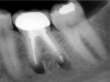 Figure 2c  The postoperative radiograph shows the root-end fillings with MTA before wound closure.