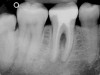 Figure 4a  Tooth No. 30 Nonsurgical root canal treatment had been completed 5 years before. The periapical radiograph revealed periradicular radiolucencies (periapical and in the furcation area).