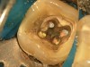Figure 4b  The patient was asymptomatic, and periodontal probing depths were within normal limits; however, a new crown restoration was planned. Nonsurgical endodontic re-treatment was initiated. The intracoronal picture shows the previously treated 4 canals with infected gutta-percha filling.