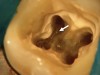Figure 4c  Under high magnification, a furcation canal (Figure 4C) and a third distal canal (Figure 4D) were located.