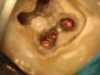 Figure 4d  Under high magnification, a furcation canal (Figure 4C) and a third distal canal (Figure 4D) were located.