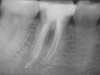 Figure 4e  The postoperative radiograph shows the re-treated tooth with 5 main canals.