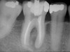 Figure 5a  Tooth No. 30 The preoperative radiograph revealed a periapical radiolucency and transported canals in the mesial root.