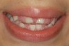 Figure 1  Heart transplant-associated gingival enlargement in a 16-year-old girl. Frontal view.