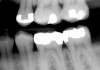 Figure 1b  Mandibular second molar with distal caries. Radiographic view.