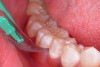 Figure 12  For another case, removing gingival excess with a disposable Bard-Parker 12A scalpel.