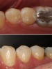 Figure 13  Completed restoration of the mandibular second premolar.