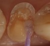 Figure 3  A primer was applied to the enamel and dentin with a microbrush applicator using a light scrubbing motion for 30 seconds.
