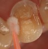 Figure 4  An adhesive was then applied to the enamel and dentin surfaces using a scrubbing motion with a microbrush applicator.