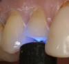 Figure 6  The dentin adhesive was fully light-polymerized for 30 seconds Figure 14 A map of the staining scheme with a red wax margin liner pencil on the facial surface of the crown was drawn.through the glyercin gel to eliminate the oxygen-inhibited layer.