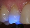 Figure 8  The restoration was then placed with a dual-cure resin cement and light-polymerized.
