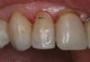 Figure 11 After completing the tooth preparation on a maxillary right lateral where the patient had recurrent decay around the existing restoration margin, activated Brush&Bond was applied for 20 seconds. An air-water syringe was used to remove the excess adhesive and evaporate the solvents and water and then light-polymerized for 10 seconds.