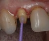 Figure 12   After completing the tooth preparation on a maxillary right lateral where the patient had recurrent decay around the existing restoration margin, activated Brush&Bond was applied for 20 seconds. An air-water syringe was used to remove the excess adhesive and evaporate the solvents and water and then light-polymerized for 10 seconds.
