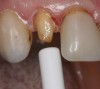 Figure 13  After completing the tooth preparation on a maxillary right lateral where the patient had recurrent decay around the existing restoration margin, activated Brush&Bond was applied for 20 seconds. An air-water syringe was used to remove the excess adhesive and evaporate the solvents and water and then light-polymerized for 10 seconds.