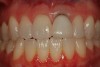 Figure 1  A retracted preoperative view of tooth Nos. 8 and 9 showing disparate gingival heights and a dark root that is visible apical to the crown margin of tooth No. 9.
