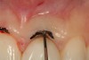 Figure 3  A periodontal probe verifies the sulcus depth at 3 mm from the gingival crest. The planned gingivectomy procedure would not require bony crown lengthening since a minimum sulcus depth of 1 mm would remain after the procedure is completed.