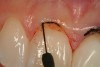 Figure 5  The needle electrode is shown removing the marked tissue to balance the gingival heights.