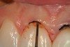Figure 6  After the procedure was complete, a periodontal probe verified that 2 mm of gingival sulcus depth remained.