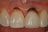 Figure 7  Tooth Nos. 8 and 9 are shown after the gingivectomy procedure with the electrosurgery needle electrode was completed.