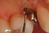 Figure 14  The restorative margin on the lingual aspect of the preparation is measured at 3 mm from the bony crest; therefore, no resective bony procedure was required.