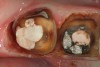 Figure 18  Troughing was performed on the distal of tooth No. 31 so that the margin and tooth surface apical to the preparation will be accessible to the light-bodied impression material.
