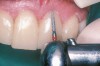 Figure 2  Fine finishing diamond marginating a gingival margin (SS White Burs, Inc).