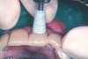 Figure 4  Cup-shaped polisher (Astropol<sup>®</sup>, Ivoclar Vivadent, Inc) smoothing the facial surface of a composite resin restoration.