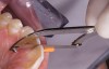 Figure 5  Intraoral saw (CeriSaw, Den-Mat Corp) being used to separate side-by-side Class 3 composite resins. Note the wedge to protect the gingival papilla when sawing between the teeth.