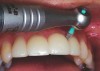 Figure 7  Profin<sup>®</sup> reciprocating handpiece (Dentatus USA Ltd) being used to finish the gingival interproximal area of esthetic bonded restorations.