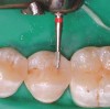 Figure 9  Gross finishing and marginating of the occlusal surface of a posterior composite resin restoration with an 8-bladed finishing bur (Brasseler USA).