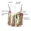 Figure 1  Comparison of healthy vs diseased periodontium. Image courtesy of the American Academy of Periodontology.