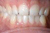 Figure 1  Early enamel loss and some dentin exposure along the cervical margins of the teeth. The cause in this case was identified when the patient admitted to toothbrushing immediately after drinking pure orange juice.