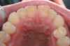 Figure 3  Left untreated and without preventive advice, erosion will continue to develop. In this case, the erosion had started to attack most tooth surfaces, making sensitivity a common finding.