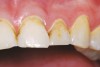 Figure 3  Close up of teeth Nos. 9 through 11.