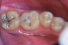 Figure 4  Caries present in tooth No. 18 and sealant of tooth No. 19 with suspected caries along margins.