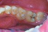 Figure 5 Caries present in tooth No. 31 and sealant of tooth No. 30 with suspected caries along margins.