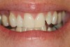Figure 2  Posttreatment view of teeth Nos. 9 and 10 esthetically restored with direct resin veneers (Premise).