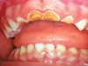 Figure 4  Classic early childhood caries demonstrating massive destruction of maxillary anterior teeth.