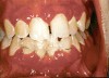 Figure 7  Dentition of an adolescent girl with type 1 diabetes, poor metabolic control, and severe periodontitis.