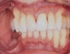Figure 8  This 55-year-old man with type 2 diabetes has obvious recession and loss of attachment.