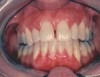 Figure 9  A patient with type 2 diabetes who has significant periodontitis, which may never be detected by a cursory oral examination.