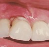 Figure 10  There can be very significant inflammation leading to evident suppuration and eventual abscess formation in patients with diabetes.