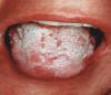 Figure 11  The enlargement of the parotid glands can lead to xerostomia, which contributes to the development of candidiasis, burning mouth and tongue, and caries.
