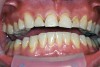 Figure 1  Front view showing significant staining of cervical areas on all teeth. This represents cyclical demineralization and remineralization over the period of time the patient wore braces, consumed large amounts of soft drinks‚Äîespecially colas‚Äîand had a smoking habit. The areas are not cavitated.